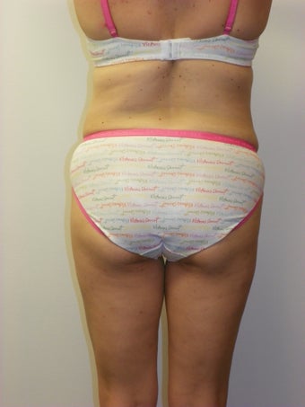 SMARTLIPO MPX