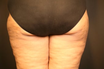 Smartlipo MPX
