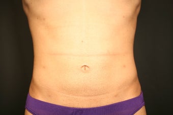 Smartlipo