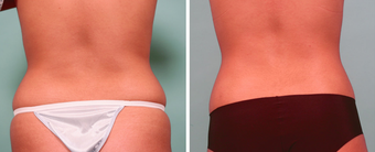 Liposuction and Smartlipo