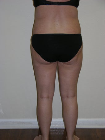 SMARTLIPO