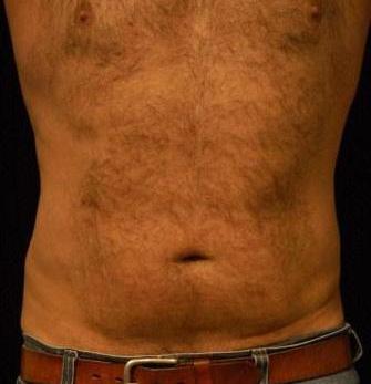 Liposucction of the Abdomen and Waist using Smart Lipo MPX