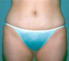Smartlipo