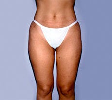 Smartlipo