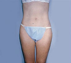Smartlipo