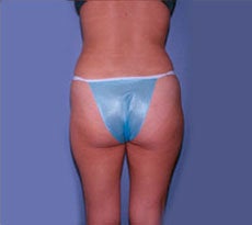 Smartlipo