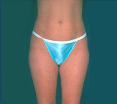 Smartlipo
