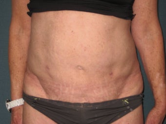 Smartlipo of the Abdomen