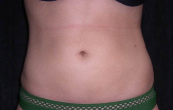 Smartlipo