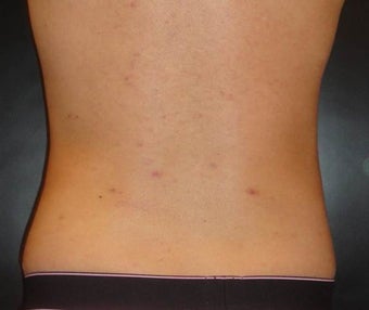 Smartlipo PRO-Sculpt
