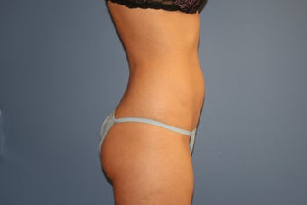 Smart Lipo MPX