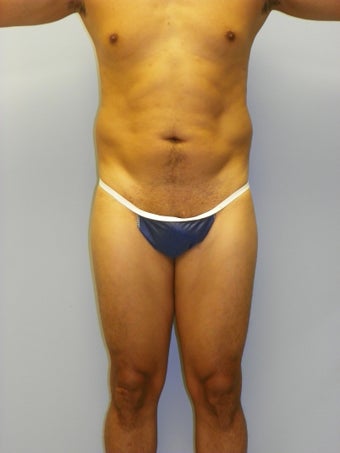 MPX SmartLipo