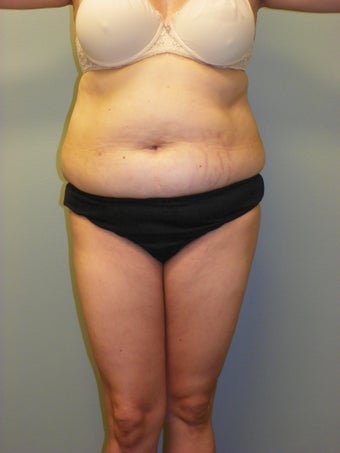 SMARTLIPO MPX