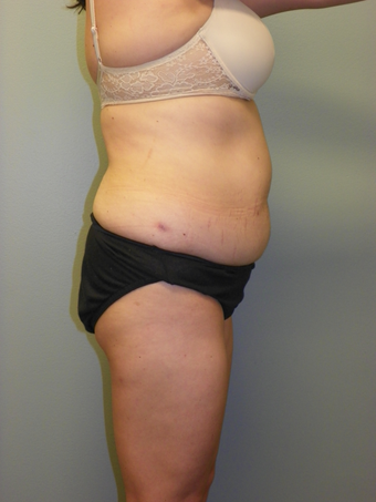 SMARTLIPO MPX