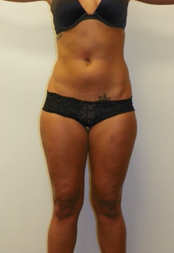  SMARTLIPO MPX