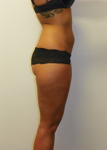 SMARTLIPO MPX