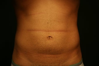Smartlipo