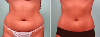 Liposuction and Smartlipo
