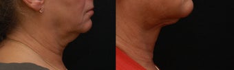 SmartLipo MPX neck & jowls