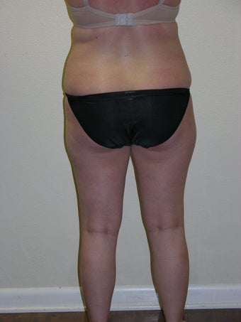SMARTLIPO