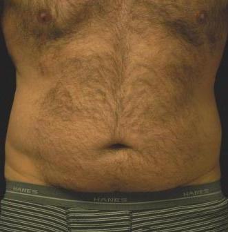 Liposucction of the Abdomen and Waist using Smart Lipo MPX