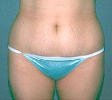 Smartlipo