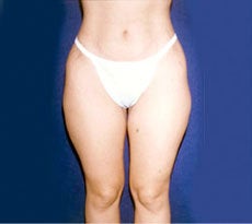 Smartlipo