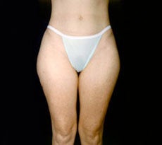 Smartlipo