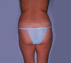 Smartlipo