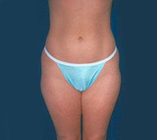 Smartlipo