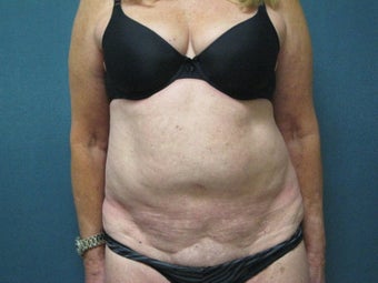 Smartlipo of the Abdomen