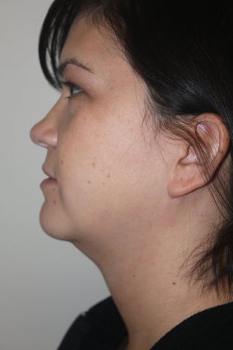 SmartLipo to the neck