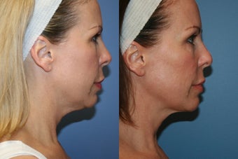 Smart Lipo MPX neck liposuction