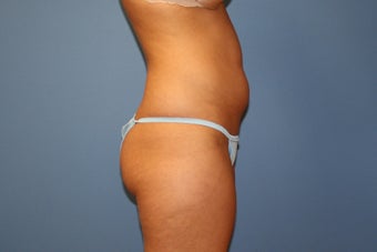 Smart Lipo MPX