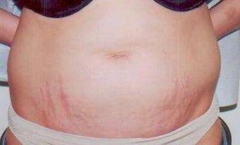 Laser Skin Resurfacing with Smartxide DOT Therapy