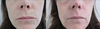 SmartXide Fractional CO2 Resurfacing