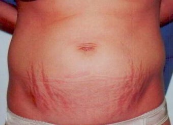 Laser Skin Resurfacing with Smartxide DOT Therapy
