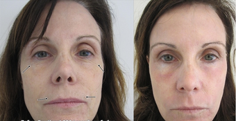 SmartXide Fractional CO2 Resurfacing