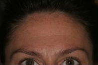 Botox