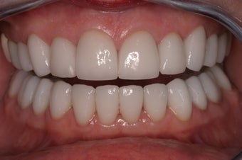 Full Mouth Reconstruction