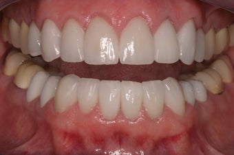 replacement of old restorations and new smile design