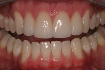 Porcelain Crowns 