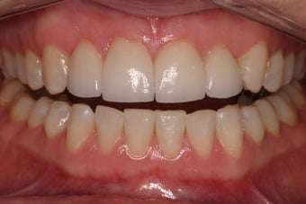 porcelain crowns to close space