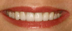 Veneers