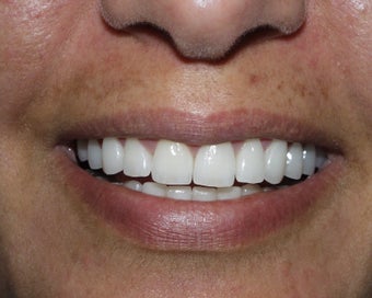 Crowns, Implants and Veneers