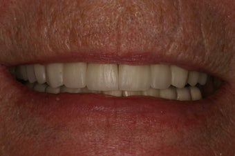 Full mouth rehabilitation.