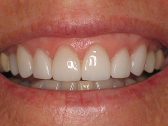 Smile Makeover
