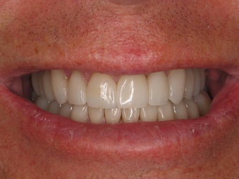 Full Mouth Makeover