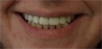 Smile Makeover with crowns and veneers