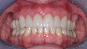 Invisalign, implants, whiteing and veneers